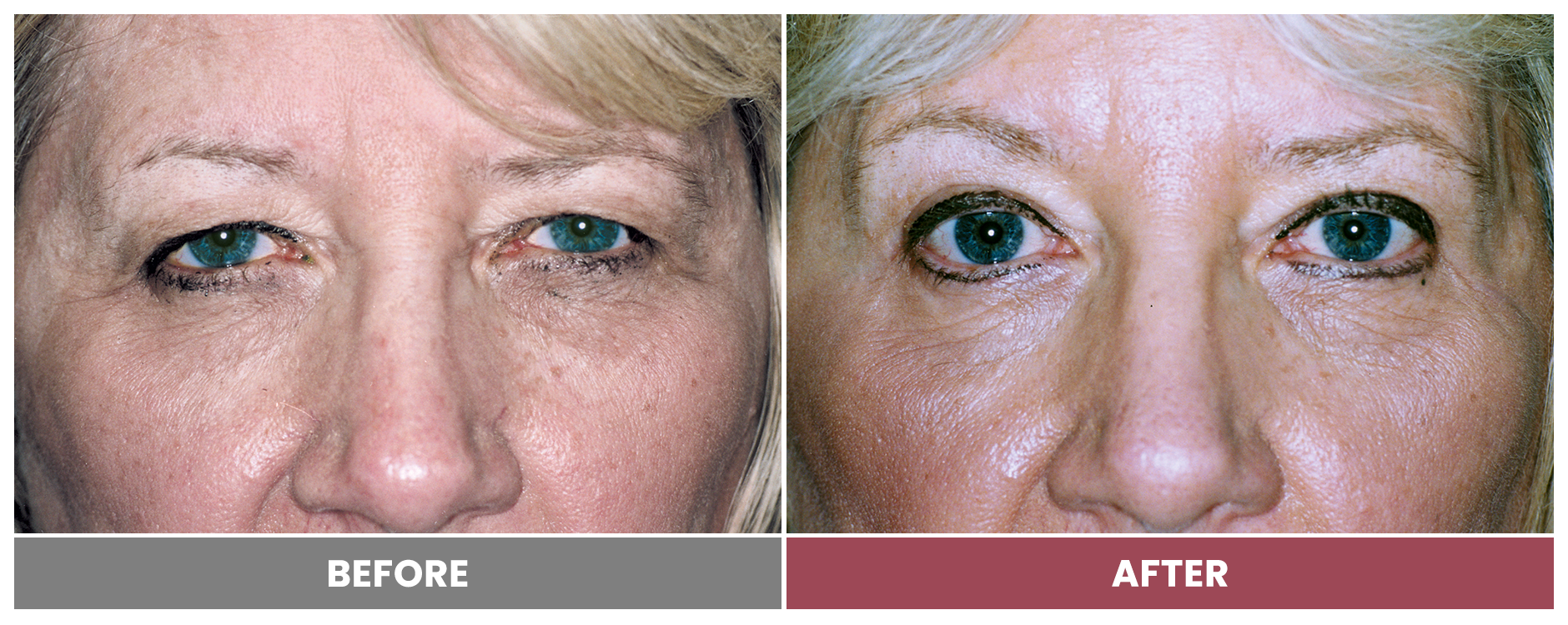 Upper Blepharoplasty - Case 40